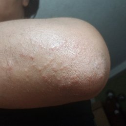 My rash My rash
