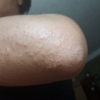 Rao Dermatology - My rash - Dermatologists Near Me - New York, New York Rao Dermatology - My rash - Dermatologists Near Me - New York, New York