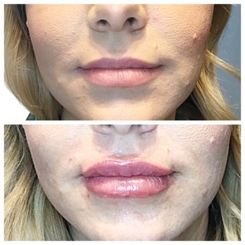 Let'z Face It - lip enhancement - Medical Spas Near Me - Chandler, Arizona Let'z Face It - lip enhancement - Medical Spas Near Me - Chandler, Arizona