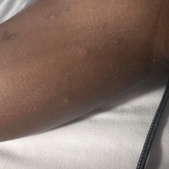 Great Wolf Lodge - Bed bug bites - Resorts Near Me - Grapevine, Texas