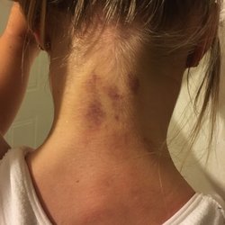 Soothing Sessions Massage - This is my daughters neck. This was taken 3 days after the massage session