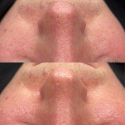 Skincation - Detox facial. We focused on treating this clients blackheads and nose congestion.