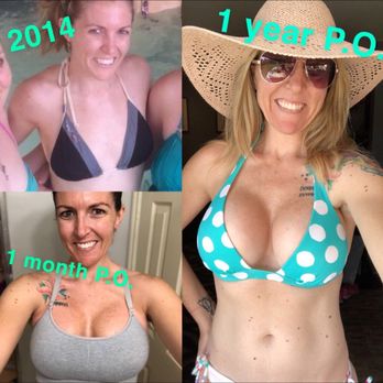 Dr K Plastic Surgery Orange County - My progression photos. Love them! - Cosmetic Surgeons Near Me - Irvine, California Dr K Plastic Surgery Orange County - My progression photos. Love them! - Cosmetic Surgeons Near Me - Irvine, California