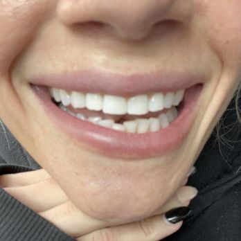 Josh Berd, DDS - The Dentist Group - Tooth filled in. - Cosmetic Dentists Near Me - San Francisco, California Josh Berd, DDS - The Dentist Group - Tooth filled in. - Cosmetic Dentists Near Me - San Francisco, California