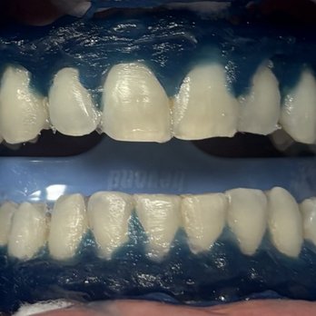 PhotoWhite - After whitening - Teeth Whitening Near Me - Frisco, Texas PhotoWhite - After whitening - Teeth Whitening Near Me - Frisco, Texas
