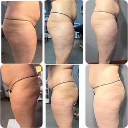 Lisa's Lil Spa Room - Lipo cavitation and cellulite treatment (3 treatments)