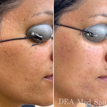 DEA Med Spa - Laser Hair Removal Near Me - Glendale, California