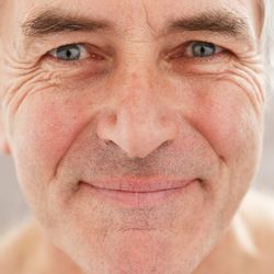 Williamsburg Plastic Surgery - Facial vein treatment reduces the appearance of small visible veins, helping restore a clearer, more even complexion.