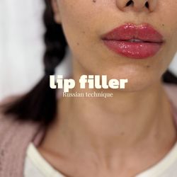 Aura Medical Spa - Our signature Russian lip filler technique