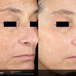 Phoenix Tattoo Removal and Skin Revitalization