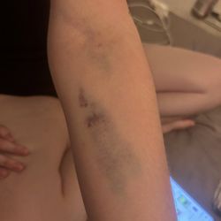 Halifax Health - Bruised arms from blown out veins :)