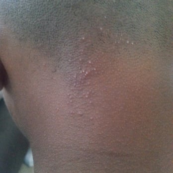 Bumpy Ingrown Hairs From Straight Razor Haircut Asked For A Fade
