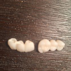 Dental Implant Center of Miami - Dr Herzogs failed implants