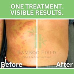 Bamboo Field NAET & Acupuncture - Rash Before & After 10yo