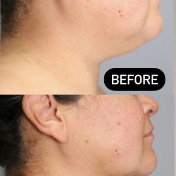 Rockstar Beauty - Chin lipo results - Medical Spas Near Me - Beverly Hills, California Rockstar Beauty - Chin lipo results - Medical Spas Near Me - Beverly Hills, California