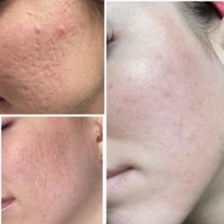 DERMÉ Med Spa - Plasma pen acne scar treatment