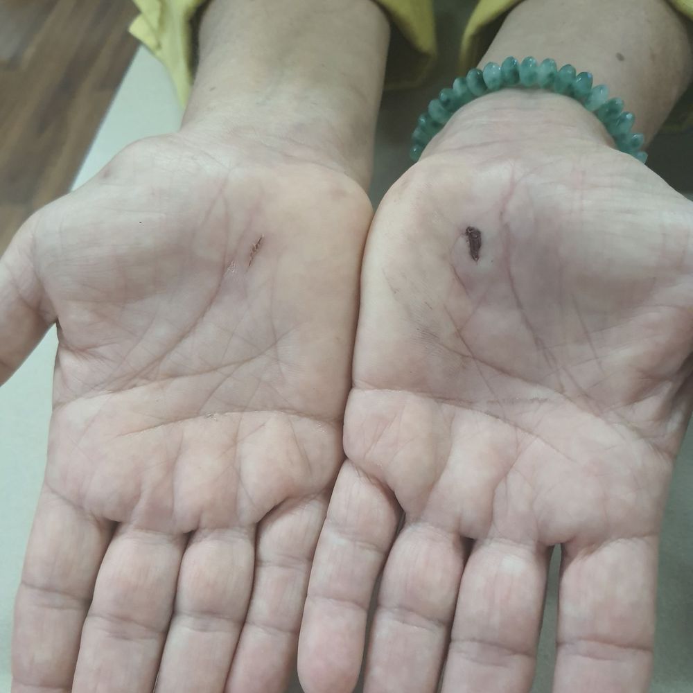 Carpal Tunnel Express - One week post op.  Healing nicely. NO PAIN. - Orthopedists Near Me - Lakeland, Florida