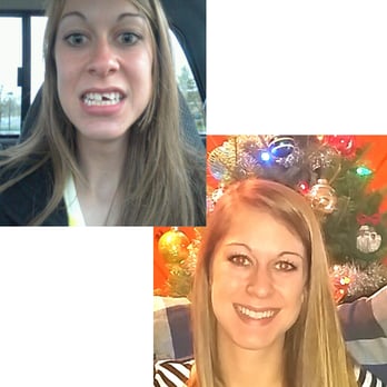 Floss - My before and after!  Sorry for the poor picture quality. 

Floss is AMAZING! - Cosmetic Dentists Near Me - San Diego, California