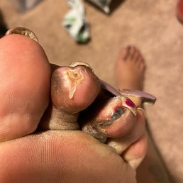 My infected toes finally healing