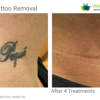 Well Medical Arts - Learn more: http://www.wellmedicalarts.com/tattoo-removal/ - Medical Spas Near Me - Seattle, Washington Well Medical Arts - Learn more: http://www.wellmedicalarts.com/tattoo-removal/ - Medical Spas Near Me - Seattle, Washington