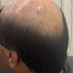 Hair Replacement Associates - Before
