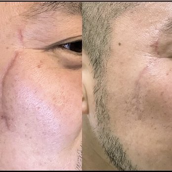 Abby Skin Clinic - One sessions progress - Skin Care Near Me - Concord, California