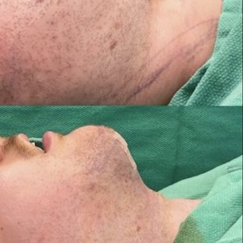 Barrett Plastic Surgery - Before and After (During Surgery!) - Cosmetic Surgeons Near Me - Beverly Hills, California Barrett Plastic Surgery - Before and After (During Surgery!) - Cosmetic Surgeons Near Me - Beverly Hills, California