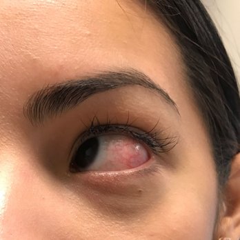 Elite Nails - My sister's eye after receiving an eye brow wax service at Elite Nails. They dropped HOT WAX in her EYE and now refuse to refund her money. - Nail Salons Near Me - Homestead, Florida Elite Nails - My sister's eye after receiving an eye brow wax service at Elite Nails. They dropped HOT WAX in her EYE and now refuse to refund her money. - Nail Salons Near Me - Homestead, Florida