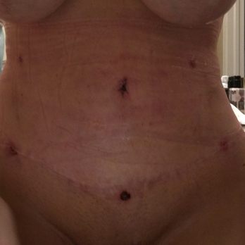 LA Plastic Surgery & Dermatology - one week post op-swollen. I am putting silicon and zinc on scars from the Lipo wand. Lacerna  mentioned laser to fix (3 quick treatments). - Dermatologists Near Me - bradenton, Florida