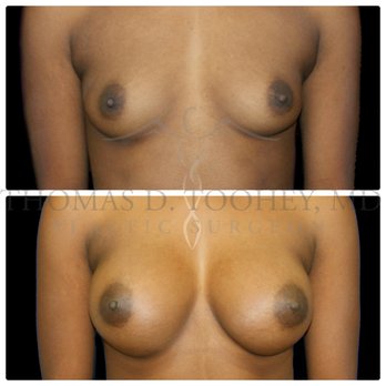 Thomas D Toohey, MD - breast augmentation - Plastic Surgeons Near Me - Newport Beach, California Thomas D Toohey, MD - breast augmentation - Plastic Surgeons Near Me - Newport Beach, California