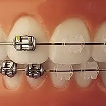 Murphy Orthodontics - Clear and metal braces availble - Orthodontists Near Me - Murphy, Texas Murphy Orthodontics - Clear and metal braces availble - Orthodontists Near Me - Murphy, Texas