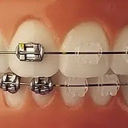 Murphy Orthodontics - Clear and metal braces availble