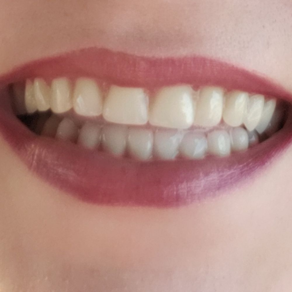 Second day status post extraction - my temp dentures. In March, after a lot of healing, I'll get an even nicer permanent pair. Second day status post extraction - my temp dentures. In March, after a lot of healing, I'll get an even nicer permanent pair.