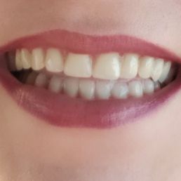 Second day status post extraction - my temp dentures. In March, after a lot of healing, I'll get an even nicer permanent pair. Second day status post extraction - my temp dentures. In March, after a lot of healing, I'll get an even nicer permanent pair.