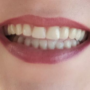 Tempe Dental Care - Second day status post extraction - my temp dentures. In March, after a lot of healing, I'll get an even nicer permanent pair. - General Dentistry Near Me - Tempe, Arizona Tempe Dental Care - Second day status post extraction - my temp dentures. In March, after a lot of healing, I'll get an even nicer permanent pair. - General Dentistry Near Me - Tempe, Arizona