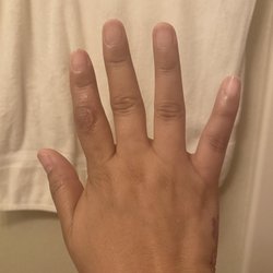 Redix Louis C Jr MD - My finger today.