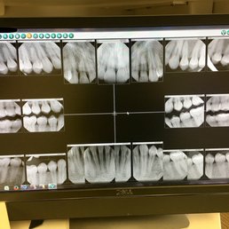 Digital X-rays of each of my teeth that were reviewed individually with me by Dr. Mier... She even zoomed in on each area of interest! Digital X-rays of each of my teeth that were reviewed individually with me by Dr. Mier... She even zoomed in on each area of interest!