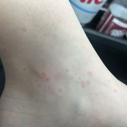 Rodeway Inn - flea bites from flea infestation