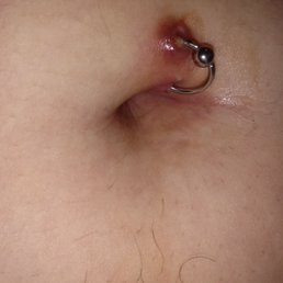 Infected belly button piercing Infected belly button piercing