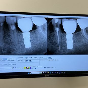 Sherman Oaks Endodontics - Before and after. The tooth to the front left saved by these guys - Endodontists Near Me - Sherman Oaks, California Sherman Oaks Endodontics - Before and after. The tooth to the front left saved by these guys - Endodontists Near Me - Sherman Oaks, California