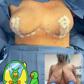 Platinum Plastic Surgery - Reduction & Lift from a J to a D - Plastic Surgeons Near Me - Las Vegas, Nevada