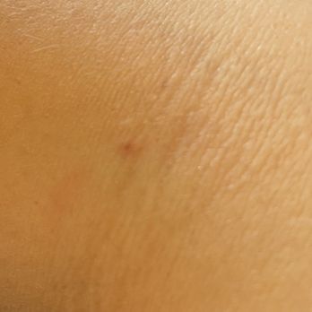 Labcorp - Almost no mark from Penn - Laboratory Testing Near Me - Philadelphia, Pennsylvania