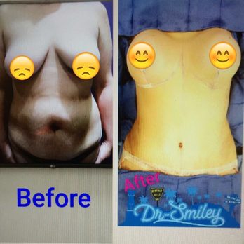 California Surgical Institute - Breast lift with implants and tummy tuck (no photos of the bbl) - Cosmetic Surgeons Near Me - Brea, California