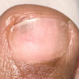 This is the spot underneath my toe nail that raised concern. I had  gel polish removed which caused my nail bed to appear brittle/thin