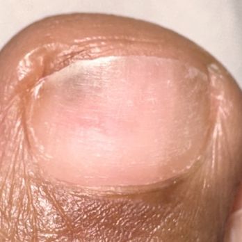 Douglas Robinson DPM - This is the spot underneath my toe nail that raised concern. I had gel polish removed which caused my nail bed to appear brittle/thin - Podiatrists Near Me - Campbell, California Douglas Robinson DPM - This is the spot underneath my toe nail that raised concern. I had gel polish removed which caused my nail bed to appear brittle/thin - Podiatrists Near Me - Campbell, California