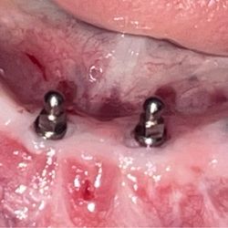 Carlos Abreu - 4x Dental Implants for a atrophied mandibular ridge