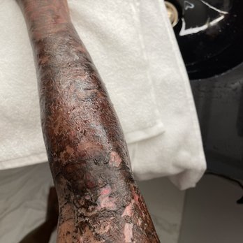Zapatat - Tattoo Removal Near Me - Arlington, Virginia