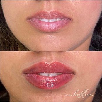 holli Aesthetics - Lutz - holli b&a 1 - Medical Spas Near Me - Lutz, Florida holli Aesthetics - Lutz - holli b&a 1 - Medical Spas Near Me - Lutz, Florida