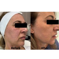 Get Glowing Medspa - Treatment: Essential Renewal Program.
Results after 4 months