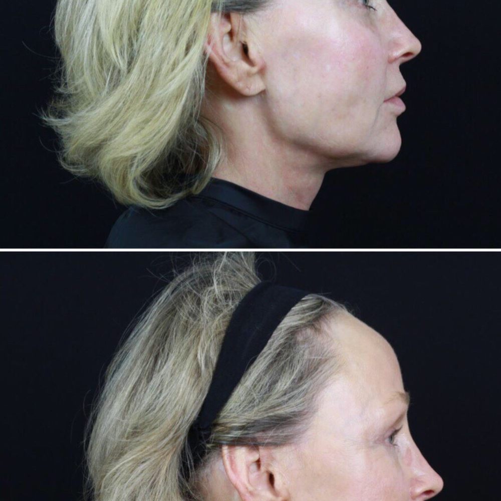Rian A Maercks, MD - Before and after side view - Cosmetic Surgeons Near Me - Miami, Florida Rian A Maercks, MD - Before and after side view - Cosmetic Surgeons Near Me - Miami, Florida
